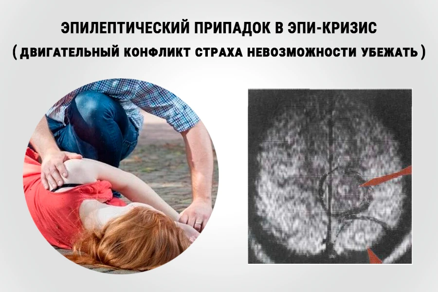 Эпилептический припадок в эпи-кризис: человек на земле, которого поддерживает близкий, и КТ-снимок мозга со стрелками у двух Очагов Хамера в двигательном и сенсорном центре правого полушария — следов зависших моторного и сенсорного конфликтов
