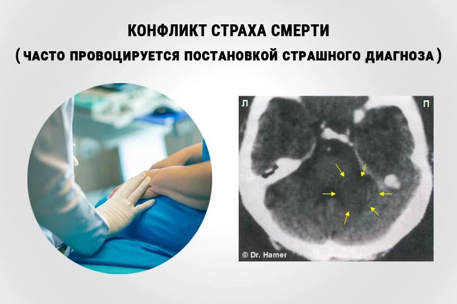 КТ-снимок мозга: жёлтые стрелки указывают на отёк Очага Хамера (тёмное пятно) в реле лёгочных альвеол — след решённого конфликта страха смерти в фазе исцеления PCL-A; слева врач поддерживающе держит пациента за руку