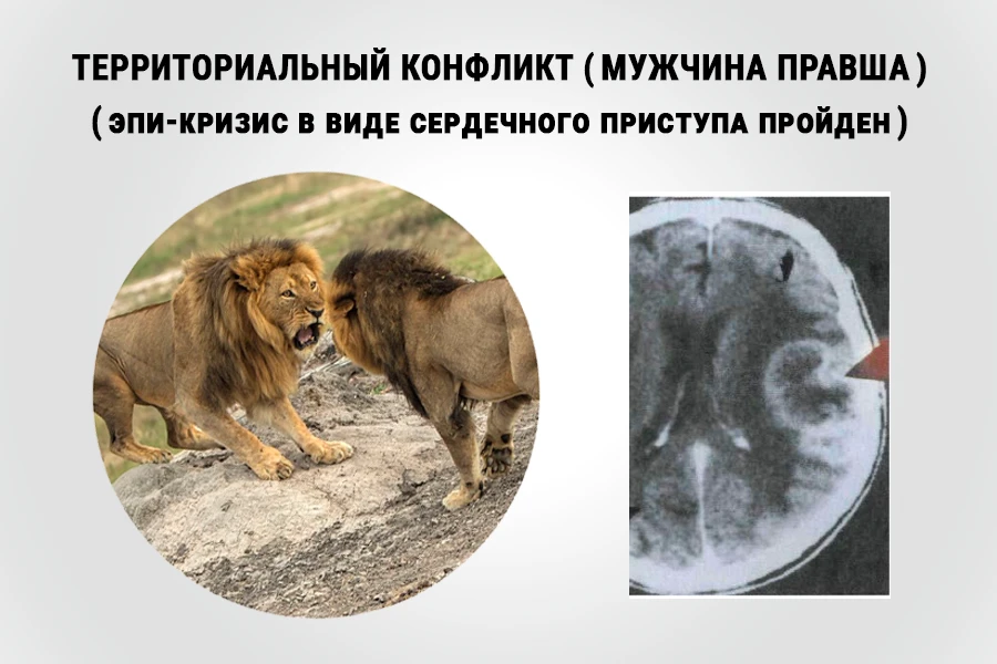 Территориальный конфликт у мужчины-правши: два льва в противостоянии за территорию и КТ-снимок мозга со стрелкой у плотного глиального кольца (рубца) вокруг Очага Хамера возле реле коронарных артерий — признак решённого конфликта и пройденного сердечного эпи-кризиса
