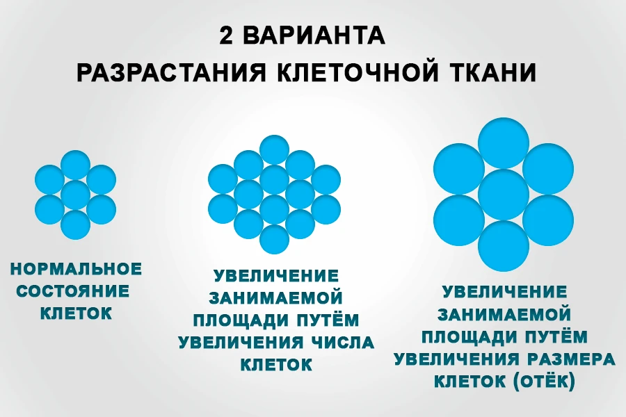 Два варианта разрастания клеточной ткани в ГНМ: нормальное состояние клеток, увеличение числа клеток (рост опухоли путём деления) и увеличение размера клеток (отёк) — механизмы формирования миомы и других заболеваний по 3-му закону Хамера