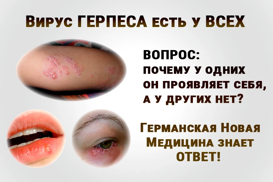 Три круглых фото проявлений герпеса: на коже руки, на губах и на глазу, надписи «Вирус ГЕРПЕСА есть у ВСЕХ», «ВОПРОС: ПОЧЕМУ У ОДНИХ ОН ПРОЯВЛЯЕТ СЕБЯ, А У ДРУГИХ НЕТ?», «Новая Германская Медицина знает ОТВЕТ!»: иллюстрация к 4-му биологическому закону Хамера о том, что герпес — эктодермальный вирус, который есть у всех и активируется при конфликте разлуки